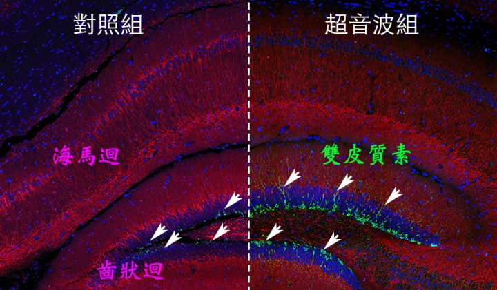 多次超音波刺激後的小鼠大腦齒狀廻，帶有雙皮質素的神經細胞顯著增加
