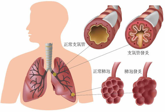 每年近5000人慢性阻塞性肺病（COPD）死亡 立即戒菸 遠離「咳、痰、喘」