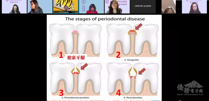 怡明醫師用圖片呈現牙周病各個階段