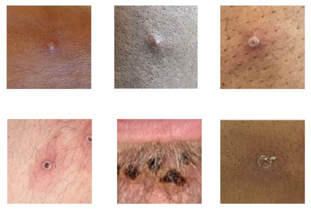 感染猴痘(monkeypox)後，皮膚出現類似天花的疱疹症狀。(圖：美國疾管署)