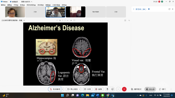 阿茲海默症對大腦的影響
