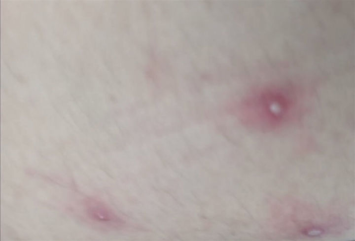 Blisters are seen on the patient's skin in Taiwan's first monkeypox case confirmed on June 24. Photo courtesy of Tainan City Public Health Bureau