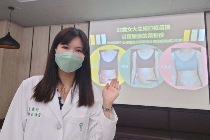 奇美醫學中心皮膚科暨醫學美容中心主治醫師莊琇真（圖）28日在院內衛教宣導會中，以施打疫苗引發嚴重藥物疹個案，說明治療方式。