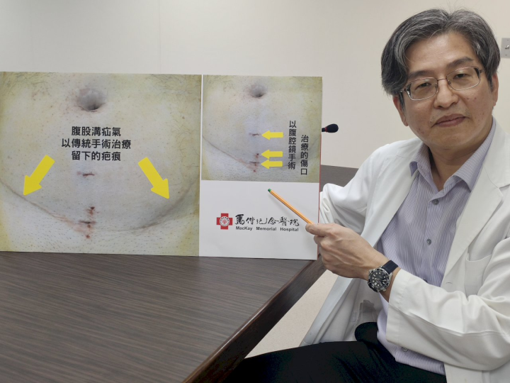 蔡家騏醫師說明以腹腔鏡手術治療疝氣，傷口小、復原快。(馬偕醫院提供)