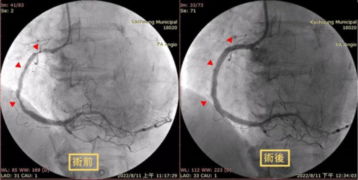 63歲大學教授近日忽然感覺胸口悶痛，且疼痛感輻射到脖子和下巴，到高雄市立聯合醫院急診才發現是嚴重急性心肌梗塞，及時手術救回一命。（高雄市立聯合醫院提供）
