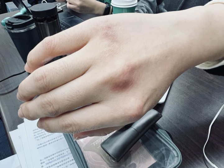 近期寒流報到氣溫驟降，醫師提醒，民眾若發現手指、腳趾顏色變白、肢體感覺麻木，可能是凍傷，要立即泡溫水回溫；低溫接觸也容易產生凍瘡，若不及時就醫，恐會損害皮膚及神經。