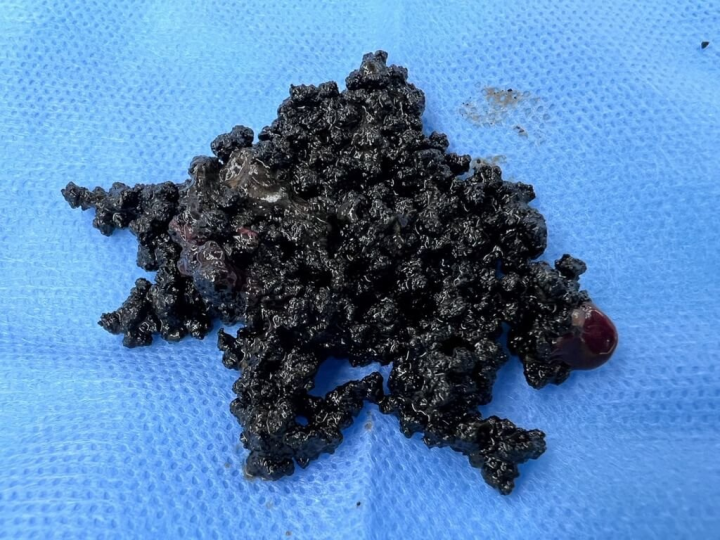 50歲許小姐長期脹氣、上腹悶痛，經檢查發現是膽囊炎，醫師手術取出膽囊，內有多顆如「魚子醬」狀的膽結石。（高醫岡山醫院籌設處提供）