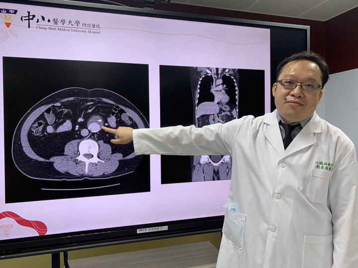 中山醫學大學附設醫院心臟血管外科主治醫師劉庭銘（圖）在記者會中說明，一名年逾50歲工程師在半年前驚覺走路時容易腿酸，躺下時能感覺肚臍旁一跳一跳的凸起，甚至用力觸摸時能感受到硬塊，檢查過後發現是「腹主動脈瘤」。（中山附醫提供）