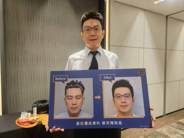 開業皮膚科診所院長蔡宗樺有家族性遺傳雄性禿，30多歲起就特別注意，當發現髮際線往後退、髮根變細時，就開始透過雄性禿口服藥物進行治療，也呼籲民眾掌握「3早」秘訣，早注意、早發現、早治療。