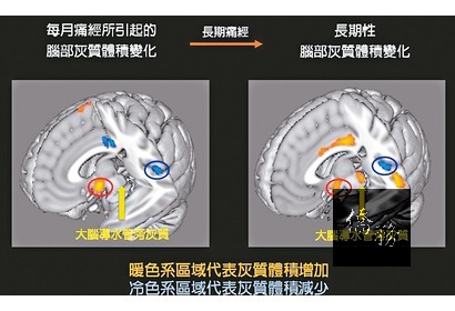 經痛是很多女性的困擾，它可能跟腦部變異有關。