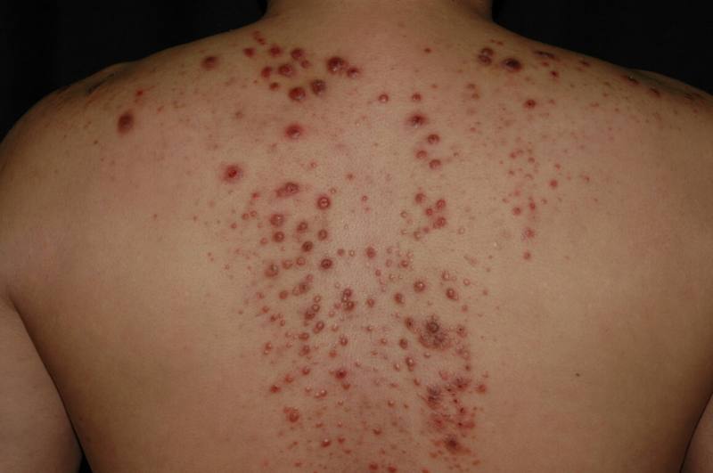 台大醫院皮膚部主任蔡呈芳18日指出，結節性癢疹是一種慢性皮膚疾病，好發於壯年及中老年人，病灶外觀有明顯較大、偏硬如米粒或碗豆般的顆粒狀結節，甚至融合成板塊。（蔡呈芳提供）