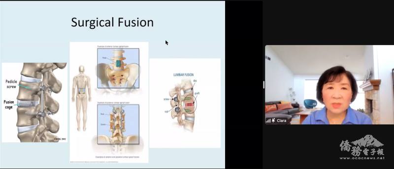 薛正和解說脊椎固定手術的原理及適用對象
