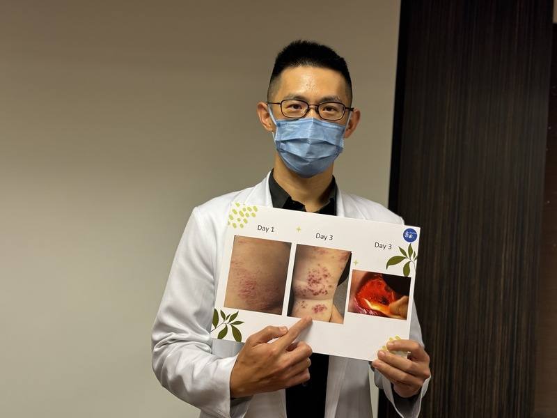 類流感疫情創近10年同期新高，有10歲男童發高燒，且同班同學好幾人都是流感確診，因此這名男童被安排克流感治療，但後續出現腳底紅疹、喉嚨痛等症狀，再就醫才發現是腸病毒。書田診所小兒科主任醫師蘇軏（圖）11日在記者會中提醒注意事項。