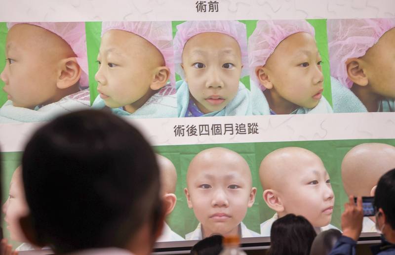 6歲的陳小弟（前）因右臉不對稱性突出就醫，經超音波導引切片及次世代定序檢測，診斷為罕見的顏面骨「惡性梭狀細胞肉瘤」，台北榮總醫療團隊透過「3D列印手術導引拼圖模型」，順利切除腫瘤