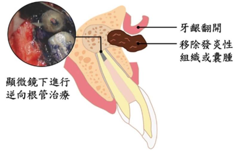 牙醫師指出，若牙齒經根管治療後症狀未緩解，或多年後又出現自發性疼痛、咬痛、悶痛、牙齦長膿包等症狀，或經X光檢查發現牙根尖周圍黑影，可能為根管系統再度感染，會導致牙根尖周圍出現發炎組織或囊腫，「根尖周圍手術」將是重要治療選擇之一。圖為手術示意圖（台北榮總提供）