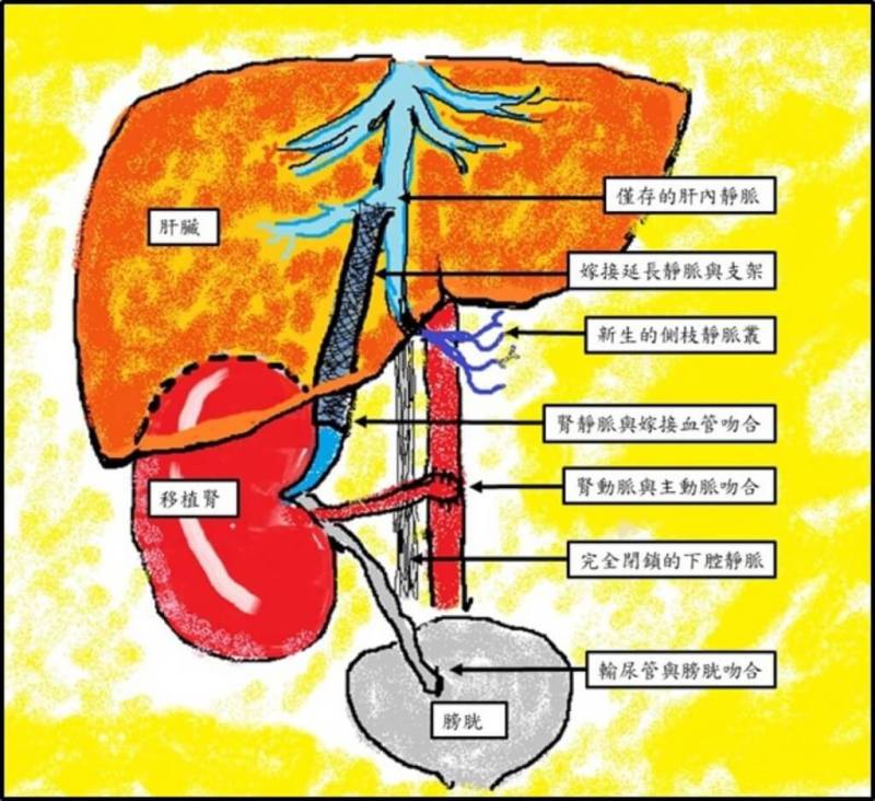 台北榮民總醫院兒童外科主任蔡昕霖說明，吳姓女童因罹腫瘤腎臟遭切除，但因下腔靜脈被腫瘤壓扁、嚴重纖維化，首次移植失敗，最終團隊以「分肝種腎」方式剖開肝臟嫁接血管，成功為她移植腎臟。此為手術示意圖。（台北榮總提供）