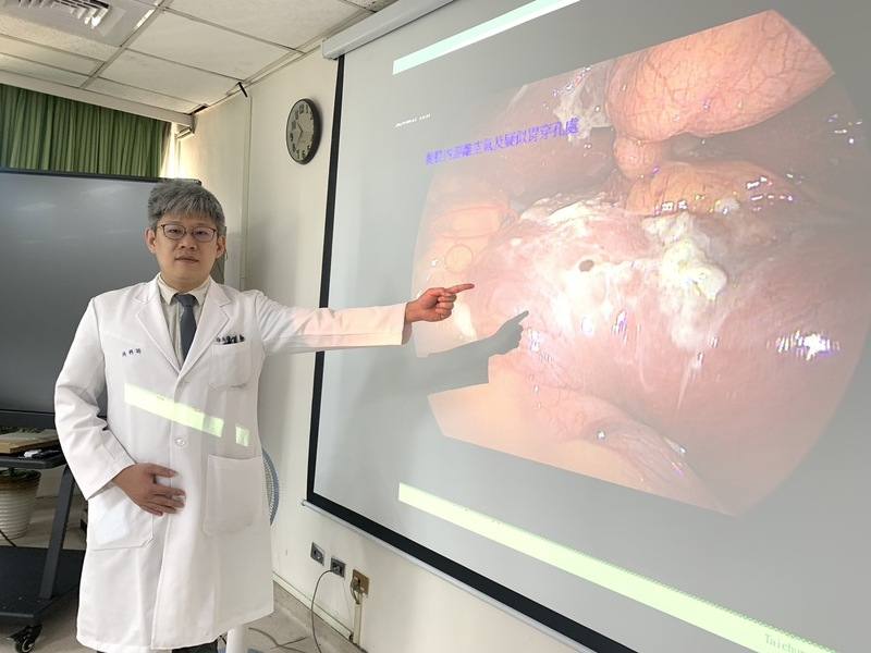 衛生福利部台中醫院19日召開記者會，消化外科醫師徐天佑指出，一名婦人因腕隧道症候群服用止痛消炎藥逾1個月，後因持續腹痛、發燒就醫，檢查發現胃潰瘍合併穿孔，緊急進行腹腔鏡胃縫合手術