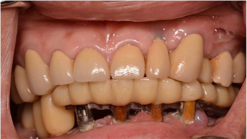 林口長庚醫院團隊研發「頭頸癌植牙重建克服張口受限免印模之數位贋復精準套件」，助牙關緊閉、張口不全患者完成複雜植牙贋復重建治療，使其咀嚼能力和生活品質得到顯著改善。（長庚醫院提供）