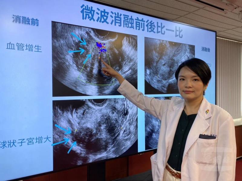 臺中榮總婦女醫學部醫師謝筱芸說明，透過超音波可見子宮肌腺症患者的子宮有血管增生情形。（臺中榮總提供）