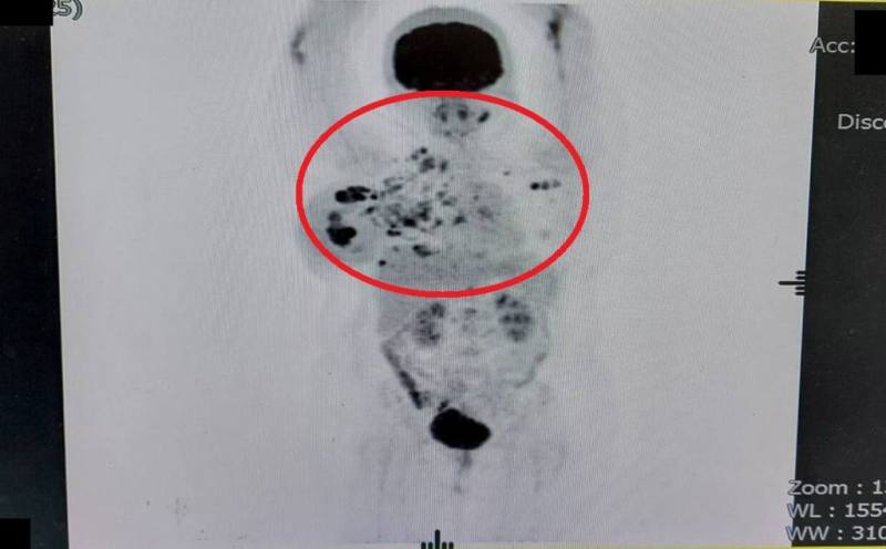 苗栗縣大千綜合醫院表示，發炎性乳癌因腫瘤細胞快速分裂及生長，阻塞乳房皮膚內的淋巴管，導致乳房出現廣泛性腫脹、發紅、發熱、疼痛等類似乳腺炎的症狀，癌細胞的侵襲性高，容易擴展，是少見且危險的乳癌類型。（大千綜合醫院提供）
