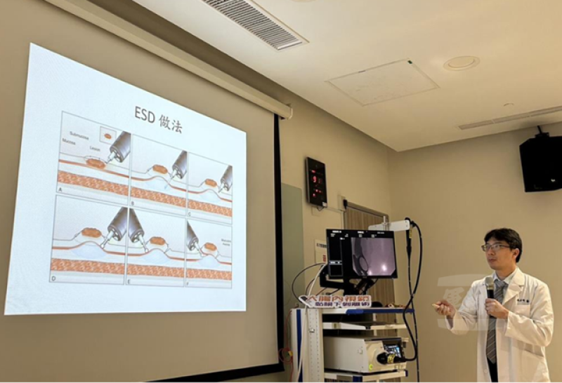 內視鏡黏膜下剝離術（ESD）已成為治療早期消化道癌症的重要技術。（屏東榮總提供）