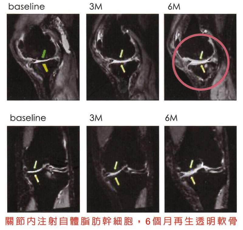 「自體脂肪幹細胞治療退化性關節炎及膝關節軟骨缺損」是透過取皮下脂肪，再經由特殊的技術，分離出脂肪幹細胞加以培養，之後再以關節注射方式治療，透過其自我更新、再生修復以及免疫調節的能力，讓受關節炎所苦的民眾重拾「膝」望。（振興醫院提供）
