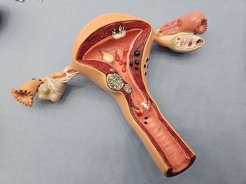 子宮頸癌是常見且可預防的癌症，抹片檢查只需6分鐘，符合資格的女性可利用免費篩檢機會定期檢查