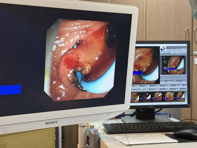 澎湖醫院日前順利完成首例內視鏡逆行性膽胰管攝影術（ERCP），為87歲老婦取出2顆結石，手術時間約50分鐘，過程順利。（衛生福利部澎湖醫院提供）