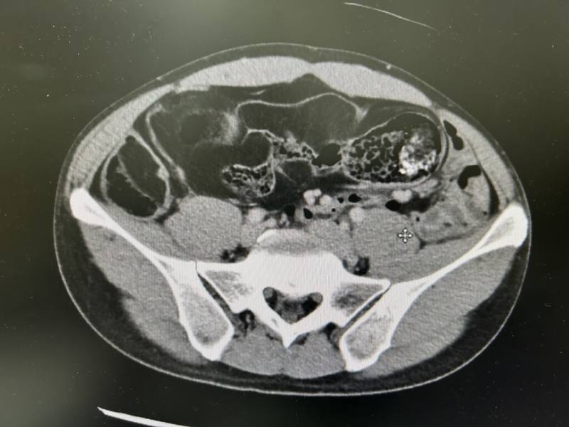 台北中山醫院近日完成一例極為少見的腸道手術，因長期腹脹就醫的34歲男性患者末端小腸嚴重糾結，腸腔內填滿脂肪樣腫瘤與軟便，並合併無數大小不一的腸憩室，經歷3小時以上剝離與切除，醫療團隊成功清除總重達2.5公斤的病變組織。（台北中山醫院提供）