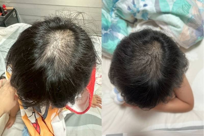 根據香港研究顯示，COVID-19疫情期間出生寶寶缺少維持腸道微生態健康天然抗菌肽基因，患上濕疹等過敏症發病率較疫情前出生的嬰兒多46%。圖為幼童使用益生菌外用產品，頭皮與髮絲狀態改善，原本容易抓癢或不適情況逐漸穩定下來。（營養師羅晞蕾提供）