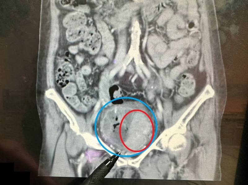 苗栗縣大千綜合醫院17日分享案例，76歲婦人持續近1個月出現無痛性血尿症狀，就醫檢查雖腎功能正常，但膀胱（藍圈處）內有1個約7x6公分的巨大腫瘤（紅圈處）。（大千醫院提供）