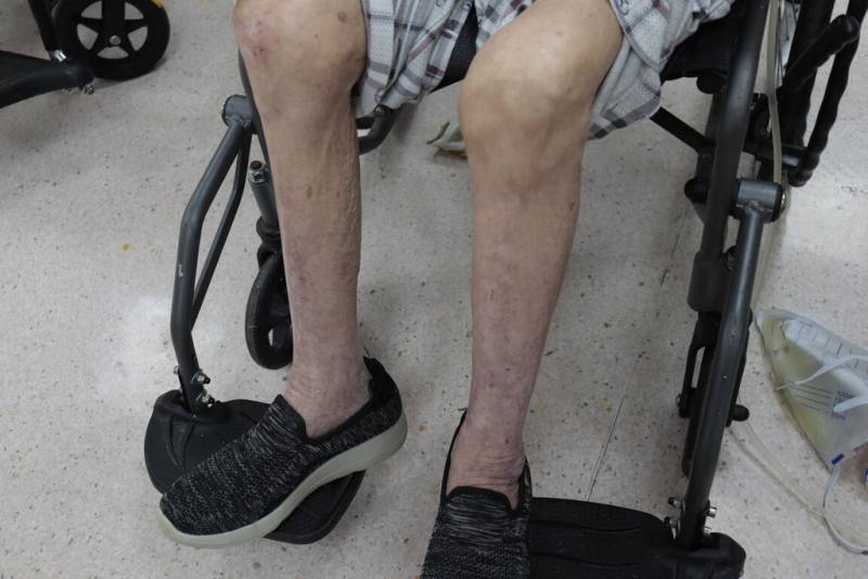 衛福部彰化醫院家醫科主任廖曜磐表示，年長者可能因退化而導致肌少症，常見雙腿外觀細小、走路難以平衡而跌倒，如又有骨質疏鬆就易骨折；很多人將長輩易跌倒情況都視為骨鬆，其實這是錯誤認知。（衛福部彰化醫院提供）