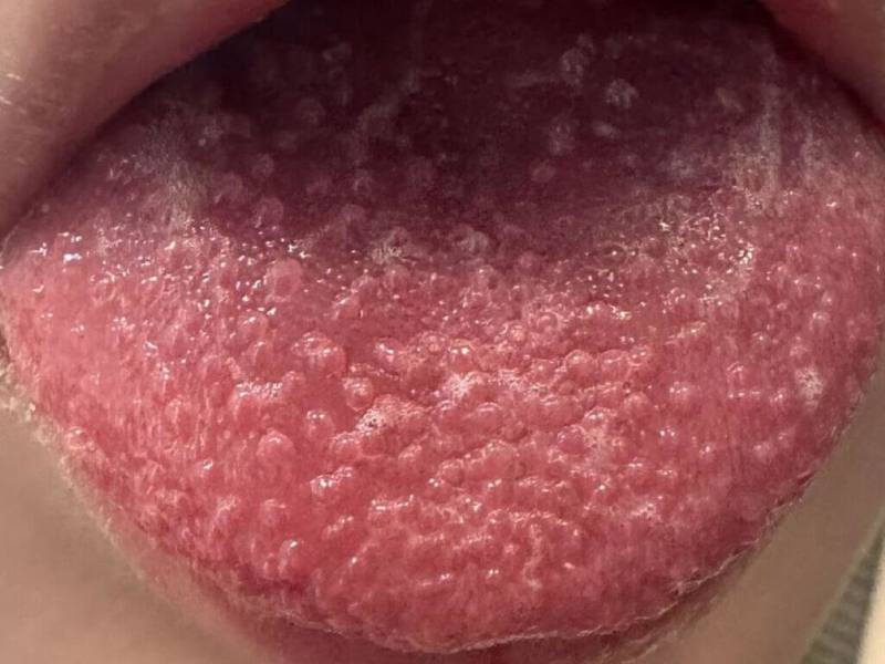 猩紅熱是A群鏈球菌引起的兒童常見疾病，好發於5至15歲學童。醫師提醒，初期與感冒類似，如發燒、喉嚨痛等，嚴重恐休克，若孩子有「草莓舌」等特徵表現，快就醫。（台北慈濟醫院提供）