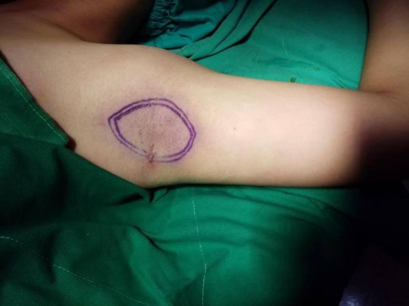 28歲林小姐獲得外派日本機會，卻因身上異味在職場遭打擊，就醫發現頂漿腺分泌異常導致狐臭，經醫師安排「迷你水刀狐臭手術」，針對腋下、會陰與乳房區域處理，才總算擺脫異味困擾。（光田綜合醫院提供）