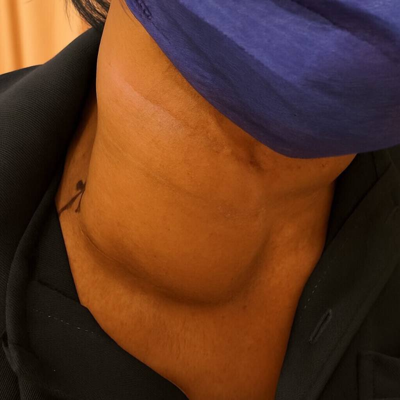 68歲廖姓男子右側頸部出現一顆腫塊，經切片檢查是伯基特淋巴瘤，腫瘤與氣管僅僅相隔0.1公分，幾乎已經壓迫到呼吸道，經化療後才撿回一命。（民眾提供）