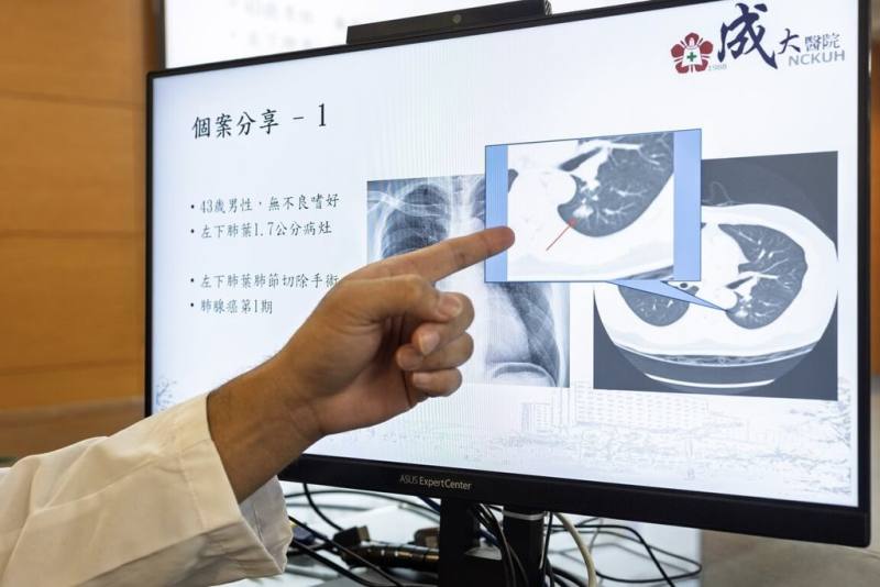 成大醫院胸腔外科醫師吳晨宇3日表示，低劑量肺部電腦斷層可協助早期診斷肺癌，精準制定治療，提升防治成效。（成大醫院提供）