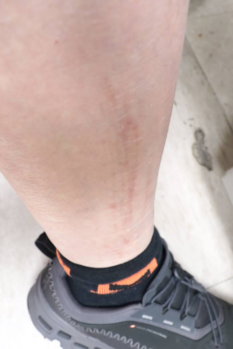 有洗腎患者近來小腿皮膚癢到抓破皮，全身骨頭痠痛，被醫師診斷為副甲狀腺功能亢進，經切除及自體移植等手術，才改善其又痛又癢的不適。（彰化醫院提供）