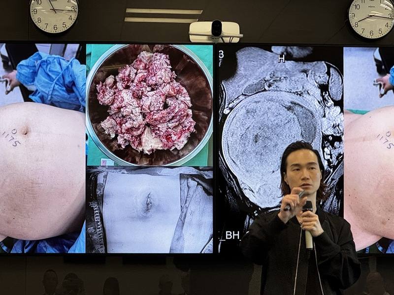 子宮肌瘤是女性骨盆腔常見腫瘤，新光醫院婦科機械手臂暨微創中心主任李偉浩15日在衛教記者會中，分享使用單孔機器手臂治療案例。