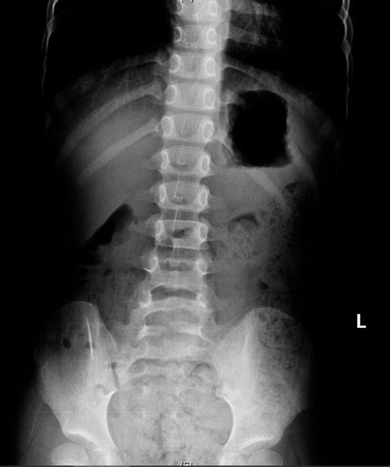 高雄一名男童近日因腹痛、冒冷汗被送到阮綜合醫院急診，X光檢查發現滿肚子都是大便；醫師提醒，長期便祕恐影響食慾與成長，家長應掌握餐後便意時機，協助孩子建立規律排便習慣。（阮綜合醫院提供）