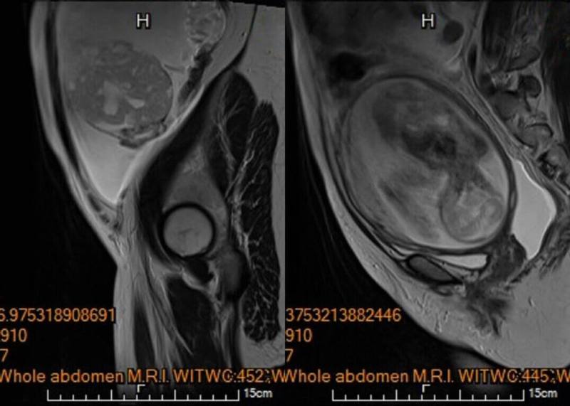 馬偕醫院指出，李小姐在妊娠20週進行第4次例行性產檢時，醫師發現其腹腔內積滿大量腹水，及左側下腹部有一個15公分大小、邊界模糊、結構複雜的卵巢腫瘤。 （馬偕醫院提供）