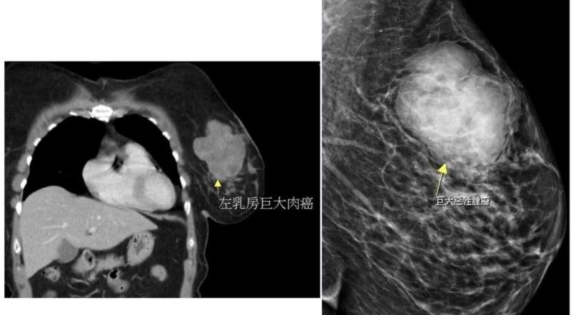 苗栗有婦人單側乳房出現硬塊，就醫檢查出近10公分大腫瘤，手術切除病理報告並非臨床常見的乳腺癌，而是發生率低且罕見出現在乳房部位的肉癌。（大千綜合醫院提供）