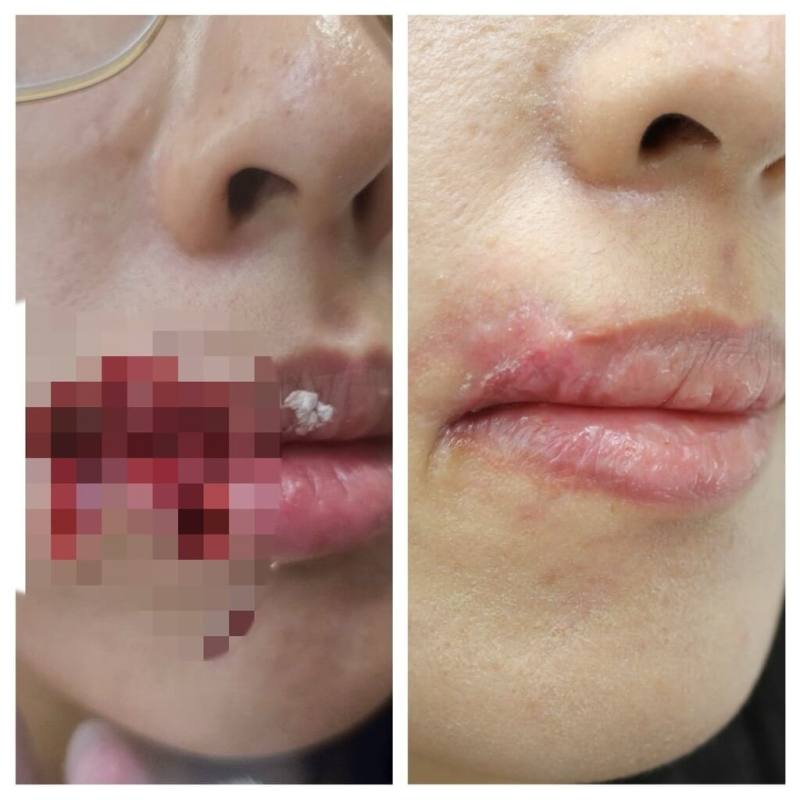 28歲胡姓女子日前遭愛犬咬掉嘴邊肉，衛福部豐原醫院團隊啟動急救流程，進行大量沖洗、清創及縫合，採「PRP（自體血小板血漿）增生療法」成功修復臉部。（豐原醫院提供）