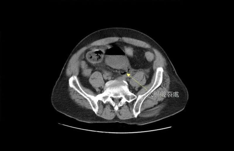 苗栗縣大千綜合醫院27日分享案例，一名男子長期便秘經常自行灌腸，因力道過猛造成直腸破裂，糞水隨破洞流進腹腔，引發嚴重腹膜炎。（大千醫院提供）