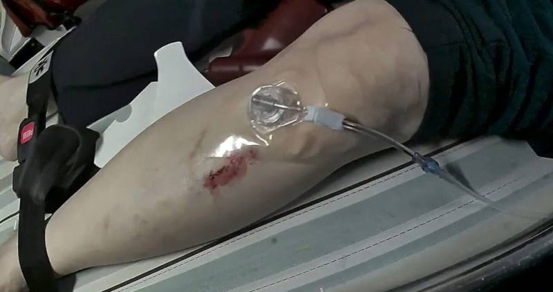 苗栗縣消防局卓蘭分隊民國114年底執行一起路倒救護案件，到場發現患者已無呼吸心跳，立即使用「骨針」急救注射腎上腺素送醫，患者經治療後順利康復，成縣內高級救護技術員以骨針急救成功康復出院首例。（苗栗縣消防局提供）