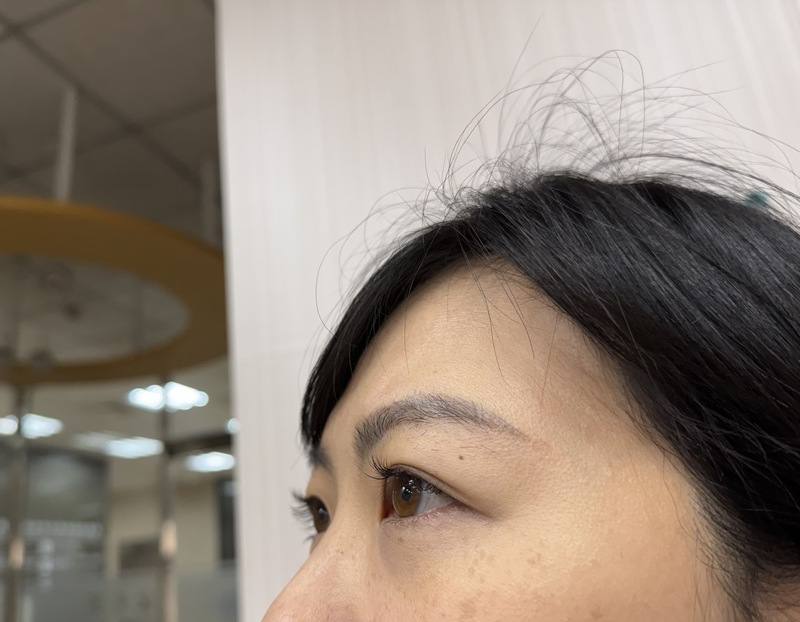 每年農曆過年前是民眾「進廠修修臉」高峰期，醫師提醒，眼皮上發現影響美觀的「黃色瘤」，這其實是身體脂質代謝異常的「求救訊號」，若沒有從控制血脂根本做起，最嚴重恐引發心肌梗塞、腦中風等致命危機。（示意圖）