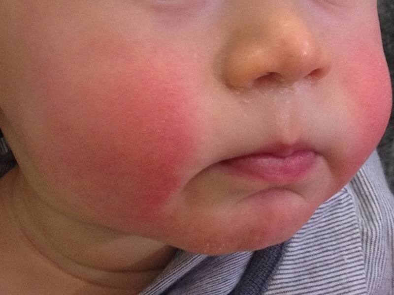 微小病毒B19又稱「傳染性紅斑」，特徵是出現類似感冒症狀後，臉頰等部位會有紅疹。（圖取自維基共享資源；作者：Gzzz，CC BY-SA 4.0）