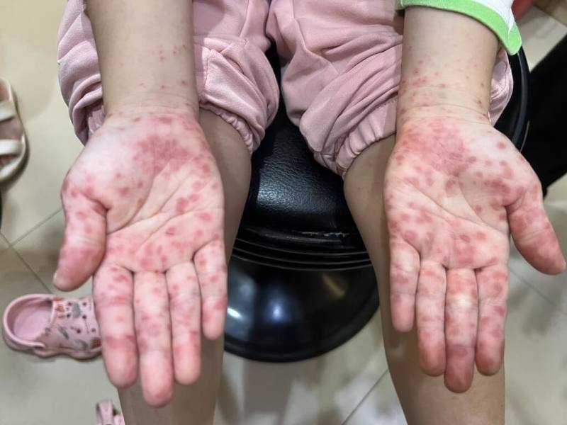 腸病毒疫情升溫，感染腸病毒患者出現手足口症，手掌長滿水泡。（兒科醫師施勝桓提供）