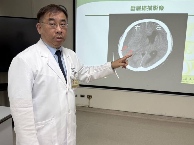 衛福部台中醫院神經外科主任陳典廷（圖）15日在記者會說明，1名水果攤商突然左邊手腳無力，持續2天未改善，以為腦中風就醫，檢查發現是「亞急性腦出血」，經緊急引流手術後康復。（醫院提供）