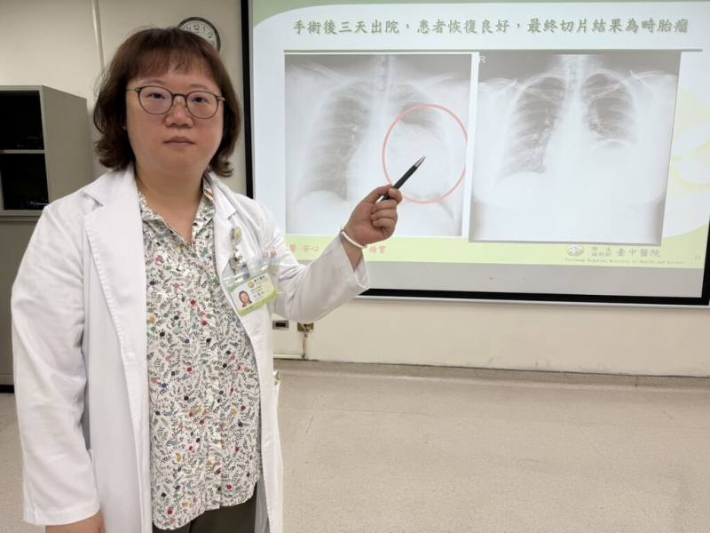 衛生福利部台中醫院胸腔外科醫師何蕙如（圖）13日在記者會說明，一名24歲女性健檢時發現左側縱隔腔有1顆15公分大腫瘤，已壓迫肺臟，卻沒有發生呼吸喘等症狀，經病理切片化驗確認是良性畸胎瘤，以微創手術切除。（台中醫院提供）